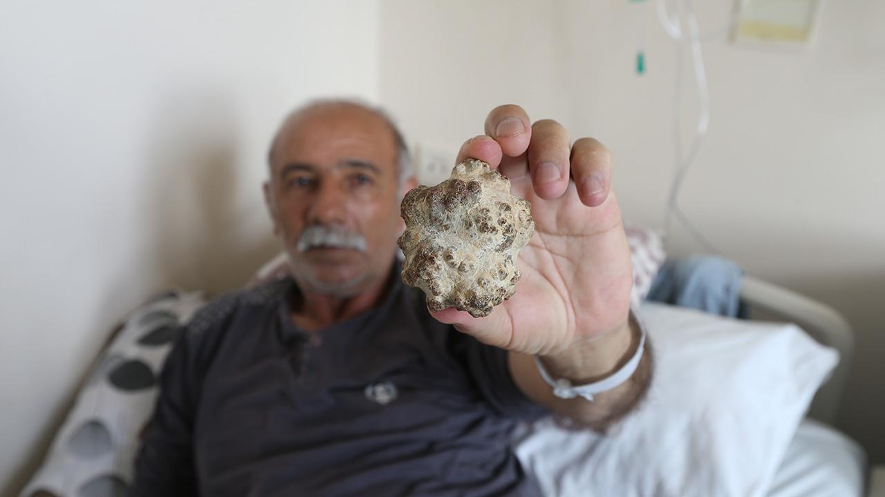 Kars'ta Ameliyatla Çıkarılan Elma Büyüklüğünde Taş